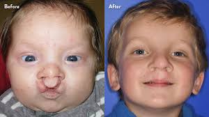 Cleft Lip And Palate Center