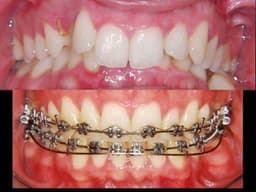 Orthodontic Treatments - Thumbnail 1