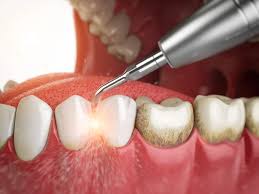 Teeth Whitening & Professional Cleaning - Main View