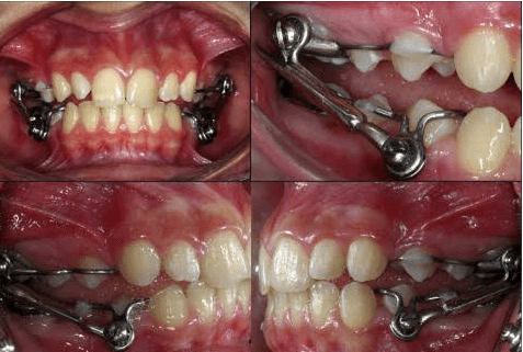 Fixed Functional Appliances for Jaw Alignment Care