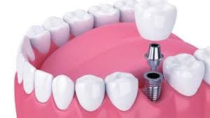 Dental Implants