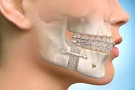 Jawline Enhancement