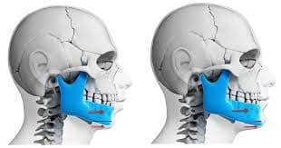 Jaw Surgery for Facial Balance and Bite Correction