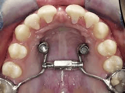 Best Dental Clinic in Silchar | Mini Screw Treatment