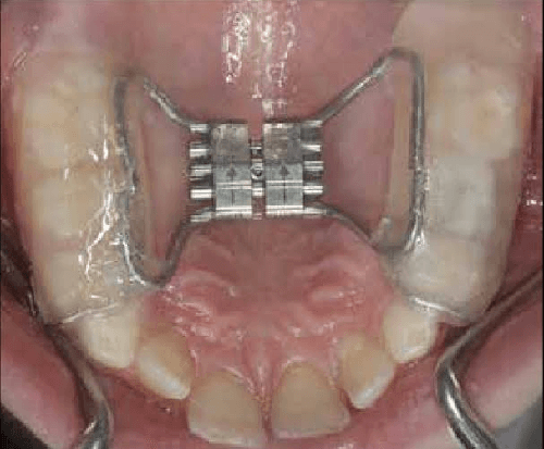 Rapid Maxillary Expansion | Dento Derma Silchar