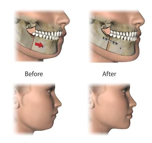 Orthognathic Surgery for Advanced Jaw Correction