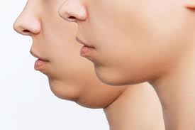 Double Chin Reduction for a Defined Facial Profile