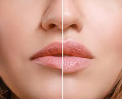 Lip Lining and Enhancement for Natural Lip Contour