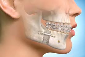 Jawline Enhancement