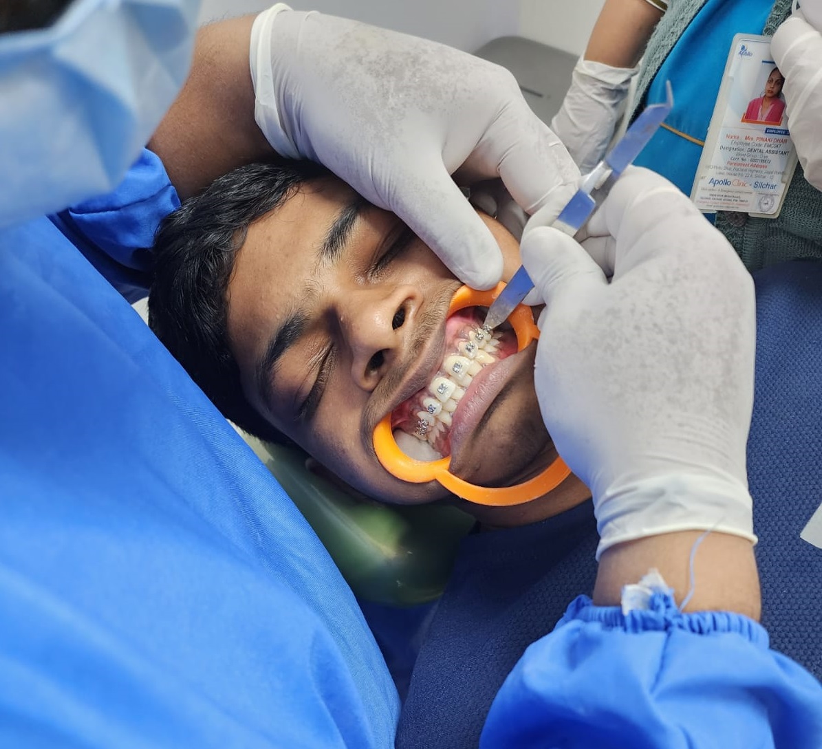 Rapid Maxillary Expansion