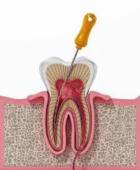 Root canal treatment procedure at Dento Derma Silchar