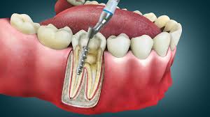 Root canal treatment steps at dental clinic in Silchar