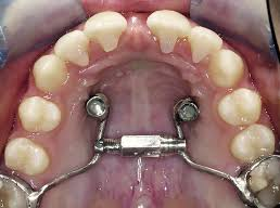 Mini Screw Assisted Treatment