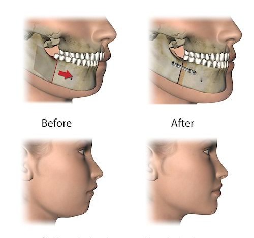 Orthognathic Surgery